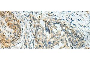 Immunohistochemistry of paraffin-embedded Human cervical cancer tissue using PLPPR5 Polyclonal Antibody at dilution of 1:120(x200) (LPPR5 anticorps)