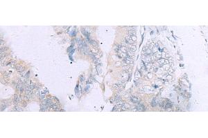Immunohistochemistry of paraffin-embedded Human colorectal cancer tissue using GPC3 Polyclonal Antibody at dilution of 1:60(x200) (Glypican 3 anticorps)