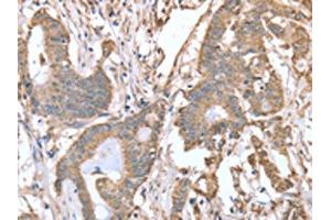 The image on the left is immunohistochemistry of paraffin-embedded Human colon cancer tissue using ABIN7128119(ABCB6 Antibody) at dilution 1/15, on the right is treated with fusion protein. (ABCB6 anticorps)