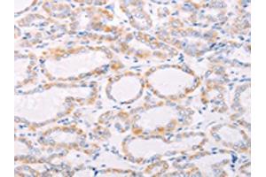 The image on the left is immunohistochemistry of paraffin-embedded Human thyroid cancer tissue using ABIN7189808(ANKRD26 Antibody) at dilution 1/25, on the right is treated with synthetic peptide. (ANKRD26 anticorps)