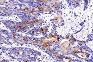 Immunohistochemistry analysis of paraffin-embedded human esophageal cancer using MIIP (ABIN7074626) at dilution of 1: 1200 (MIIP anticorps)