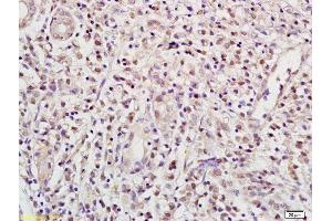 Formalin-fixed and paraffin embedded human gastric carcinoma labeled with Anti RBPJK/RBP-J Polyclonal Antibody, Unconjugated (ABIN872972) at 1:200 followed by conjugation to the secondary antibody and DAB staining (RBPJ anticorps  (AA 101-200))
