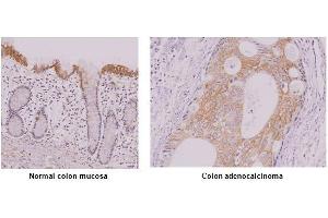 Paraffin embedded sections of normal colon mucosa and colon adenocalcinoma tissue were incubated with anti-human IRF-5 antibody (1:50) for 2 hours at room temperature. (IRF5 anticorps  (AA 176-240))