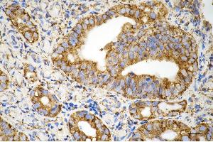 Immunohistochemistry was performed on paraffin-embedded human sigmoid colon carcinoma using prolyl 4-hydroxylase subunit beta antibody (ABIN7799920), 1:200). (Recombinant P4HB anticorps)