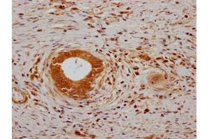 IHC image of ABIN7139767 diluted at 1:200 and staining in paraffin-embedded human gastric cancer performed on a Leica BondTM system. (CA9 anticorps  (AA 38-414))
