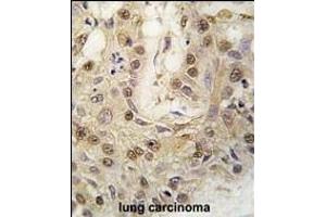 Formalin-fixed and paraffin-embedded human lung carcinoma tissue reacted with cGKII antibody (C-term) (ABIN392537 and ABIN2842089) , which was peroxidase-conjugated to the secondary antibody, followed by DAB staining. (PRKG2 anticorps  (C-Term))