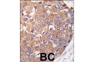 Formalin-fixed and paraffin-embedded human breast carcinoma tissue reacted with PLK2 polyclonal antibody  , which was peroxidase-conjugated to the secondary antibody, followed by DAB staining. (PLK2 anticorps  (C-Term))