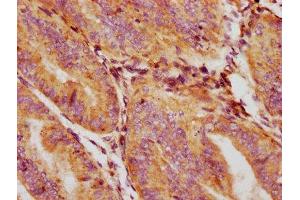 IHC image of ABIN7154549 diluted at 1:132 and staining in paraffin-embedded human endometrial cancer performed on a Leica BondTM system.