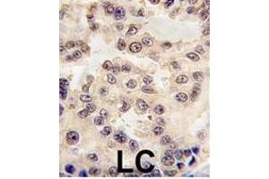 Formalin-fixed and paraffin-embedded human lung carcinoma tissue reacted with EN1 antibody (N-term) (ABIN391430 and ABIN2841422) , which was peroxidase-conjugated to the secondary antibody, followed by DAB staining.