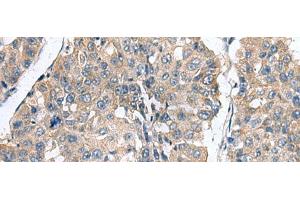 Immunohistochemistry of paraffin-embedded Human liver cancer tissue using CLEC1B Polyclonal Antibody at dilution of 1:60(x200) (C-Type Lectin Domain Family 1, Member B (CLEC1B) anticorps)
