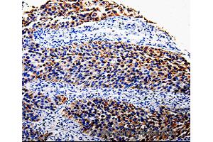 Immunohistochemistry of Human renal cancer using COX10 Polyclonal Antibody at dilution of 1:100 (COX10 anticorps)