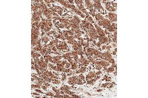 Immunohistochemical analysis of paraffin-embedded human breast carcinoma tissue using (ABIN6242215 and ABIN6577457) performed on the Leica® BOND RXm. (Cathepsin D anticorps  (AA 1-412))