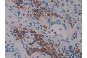 Detection of LAT2 in Human Lung cancer Tissue using Polyclonal Antibody to Linker For Activation Of T-Cells Family, Member 2 (LAT2) (LAT2 anticorps  (AA 30-209))