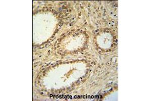 SNRNP40 Antibody immunohistochemistry analysis in formalin fixed and paraffin embedded human prostate carcinoma followed by peroxidase conjugation of the secondary antibody and DAB staining. (SNRNP40 anticorps  (AA 122-149))
