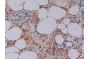 Detection of FTL in Human Skin cancer Tissue using Polyclonal Antibody to Ferritin, Light Polypeptide (FTL)