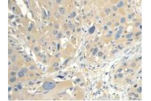 IHC-P analysis of Human Esophagus Cancer Tissue, with DAB staining. (CALML3 anticorps  (AA 1-149))