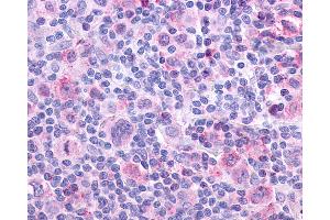 Anti-CHRM4 / M4 antibody IHC of human Lymph Node, Hodgkins Lymphoma.