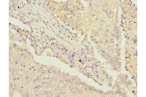 Immunohistochemistry of paraffin-embedded human lung cancer using ABIN7142207 at dilution of 1:100 (PSMD13 anticorps  (Regulatory Subunit 13))