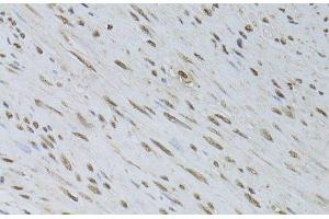 Immunohistochemistry of paraffin-embedded Human uterine cancer using HDGFRP3 Polyclonal Antibody at dilution of 1:100 (40x lens). (HDGFRP3 anticorps)