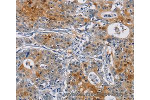 Immunohistochemistry of Human gastic cancer using GSTA2 Polyclonal Antibody at dilution of 1:50