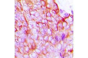 Immunohistochemical analysis of Connexin 43 (pS368) staining in human breast cancer formalin fixed paraffin embedded tissue section. (Connexin 43/GJA1 anticorps  (C-Term, pSer368))