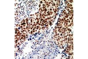 Immunohistochemical analysis of TEAD2 staining in human breast cancer formalin fixed paraffin embedded tissue section. (TEAD2 anticorps)
