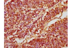 IHC image of ABIN7161476 diluted at 1:200 and staining in paraffin-embedded human lung cancer performed on a Leica BondTM system.