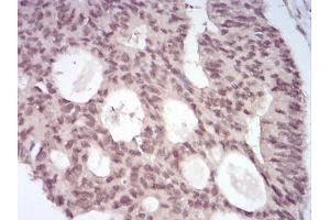 Immunohistochemical analysis of paraffin-embedded rectum cancer tissues using MGMT mouse mAb with DAB staining.