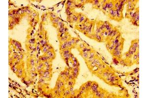 IHC image of ABIN7154498 diluted at 1:100 and staining in paraffin-embedded human cervical cancer performed on a Leica BondTM system.