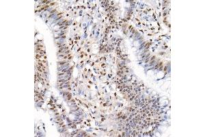 Immunohistochemistry of paraffin-embedded human colon carcinoma using Phospho-Smad2-S465/467 + Smad3-S423/425 Rabbit pAb (ABIN6135314, ABIN6136248, ABIN6136249 and ABIN6225575) at dilution of 1:50 (40x lens). (SMAD2 / SMAD3 (pSer423), (pSer425) anticorps)