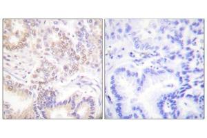 Immunohistochemistry analysis of paraffin-embedded human lung carcinoma tissue using SENP5 antibody. (SENP5 anticorps  (C-Term))