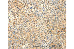 Immunohistochemistry of Human liver cancer using TRAF3IP2 Polyclonal Antibody at dilution of 1:30 (TRAF3IP2 anticorps)