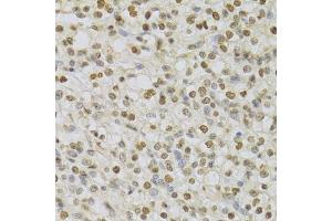 Immunohistochemistry of paraffin-embedded human kidney cancer using HDGF Antibody. (HDGF anticorps  (AA 1-240))