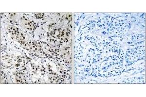 Immunohistochemistry analysis of paraffin-embedded human breast carcinoma tissue, using APBB2 Antibody. (APBB2 anticorps  (AA 471-520))