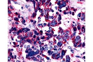 Anti-EDNRA / Endothelin A Receptor antibody IHC of human Lung, Small Cell Carcinoma.