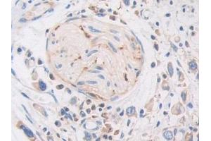 Detection of PZP in Human Stomach cancer Tissue using Polyclonal Antibody to Pregnancy Zone Protein (PZP)