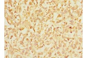 Immunohistochemistry of paraffin-embedded human melanoma using ABIN7156455 at dilution of 1:100