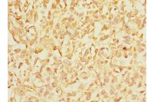 Immunohistochemistry of paraffin-embedded human melanoma using ABIN7156455 at dilution of 1:100 (CD103 anticorps  (AA 19-200))