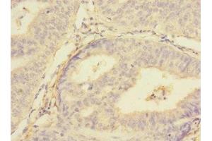 Immunohistochemistry of paraffin-embedded human endometrial cancer using ABIN7159959 at dilution of 1:100 (PMPCA anticorps  (AA 456-525))