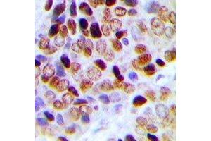 Immunohistochemical analysis of TCEAL1 staining in human prostate cancer formalin fixed paraffin embedded tissue section.