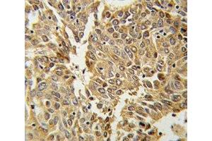 HIF1 alpha antibody IHC analysis in formalin fixed and paraffin embedded lung carcinoma. (HIF1A anticorps  (AA 1-30))