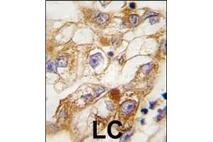 Formalin-fixed and paraffin-embedded human lung carcinoma tissue reacted with RGS19 Antibody (S24) (ABIN6243053 and ABIN6577359) , which was peroxidase-conjugated to the secondary antibody, followed by DAB staining.