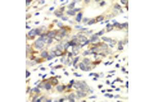 Immunohistochemistry of paraffin-embedded human colon carcinoma using APLP1 antibody (ABIN5971433) at dilution of 1/100 (40x lens).