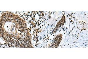 Immunohistochemistry of paraffin-embedded Human esophagus cancer tissue using GLI1 Polyclonal Antibody at dilution of 1:40(x200) (GLI1 anticorps)