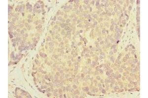 Immunohistochemistry of paraffin-embedded human gastric cancer using ABIN7163860 at dilution of 1:100 (GALNT12 anticorps  (AA 1-272))