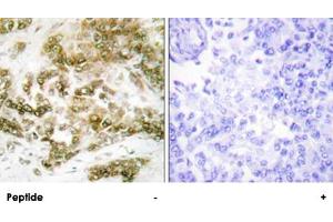 Immunohistochemistry analysis of paraffin-embedded human breast carcinoma tissue using TBX15/TBX18 polyclonal antibody . (T-Box 15 anticorps)
