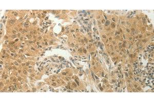Immunohistochemistry of paraffin-embedded Human lung cancer tissue using SLC8A3 Polyclonal Antibody at dilution 1:70 (SLC8A3 anticorps)
