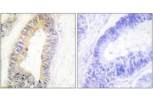 Immunohistochemistry analysis of paraffin-embedded human colon carcinoma tissue, using ZNF638 Antibody. (ZNF638 anticorps  (AA 1271-1320))