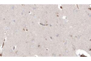 ABIN6272914 at 1/100 staining Human brain cancer tissue by IHC-P. (DHRS3 anticorps  (Internal Region))