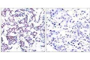 Immunohistochemical analysis of paraffin-embedded human breast carcinoma using JunB (phospho-Ser259) antibody (E011027). (JunB anticorps  (pSer259))
